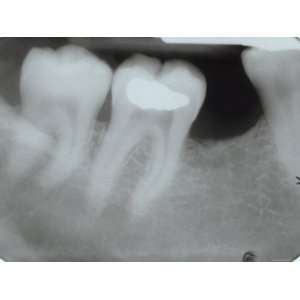  X Ray of Wisdom Tooth and Molars in Mouth Photographic 