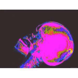  X Ray Normal Human Skull Head Face Brain Neurology 