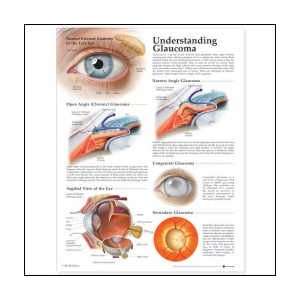  Understanding Glaucoma Anatomical Chart Laminated Health 