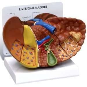 Liver Model Diseased with Cancer  Industrial & Scientific